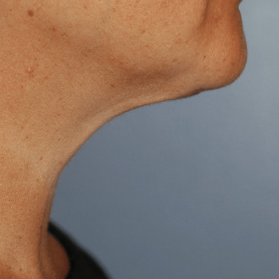 After Image: Necklift - other