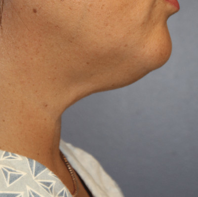 Before Image: Necklift - other