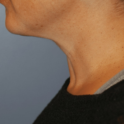 After Image: Necklift - other