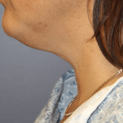 Before Image: Necklift - other