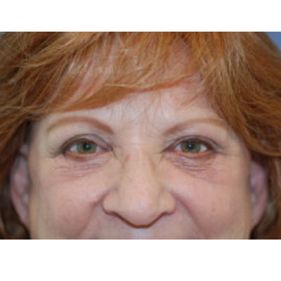 After Image: Upper and Lower Blepharoplasty - front