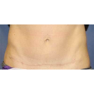 After Image: Tummy Tuck (Abdominoplasty) - front