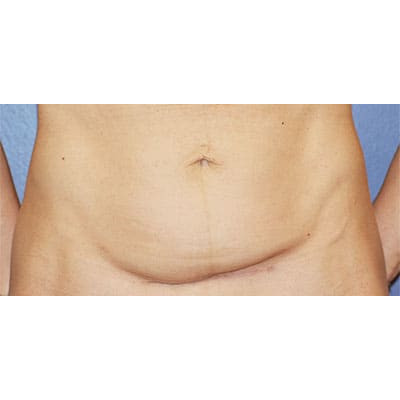 Before Image: Tummy Tuck (Abdominoplasty) - front