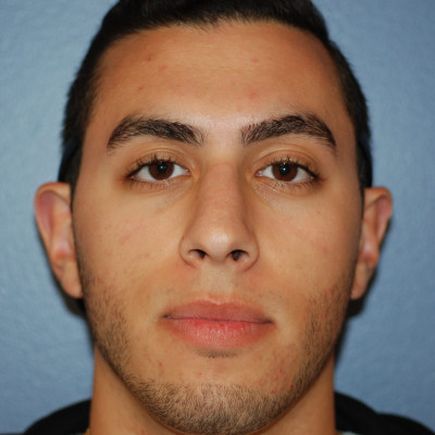 After Image: Rhinoplasty - front