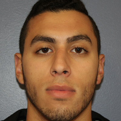 Before Image: Rhinoplasty - front