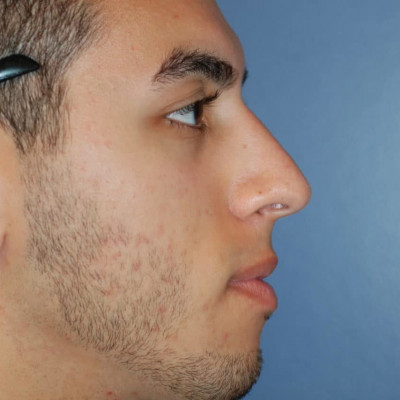 After Image: Rhinoplasty - other