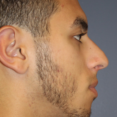 Before Image: Rhinoplasty - other