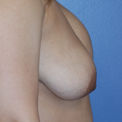 Revision Breast Augmentation with Lift
