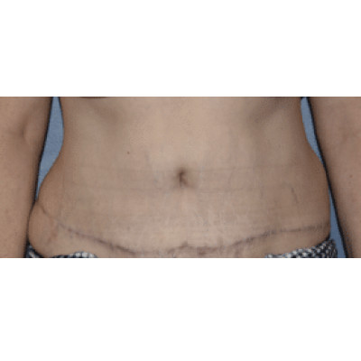 Tummy Tuck (Abdominoplasty)