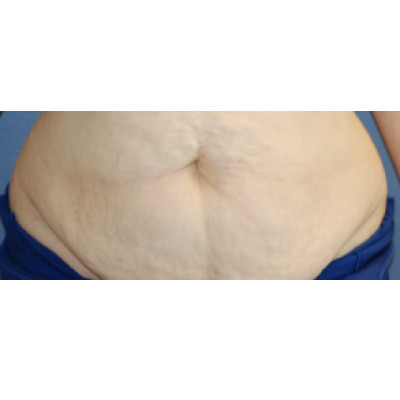 Tummy Tuck (Abdominoplasty)