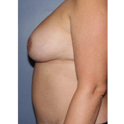 After Image: Breast Reconstruction - other