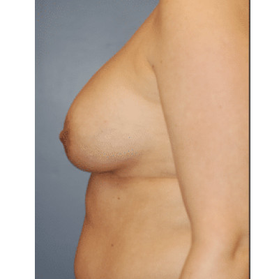 Before Image: Breast Reconstruction - other