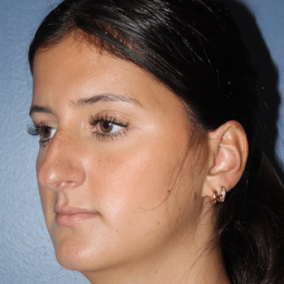 Before Image: Rhinoplasty - other