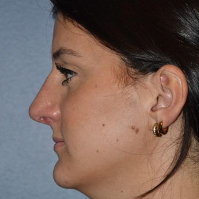 After Image: Rhinoplasty - other
