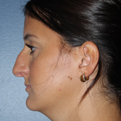 Before Image: Rhinoplasty - other