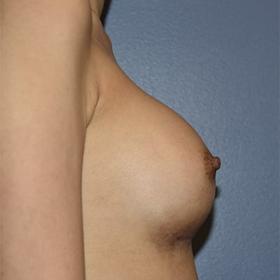 After Image: Breast Augmentation - right-side