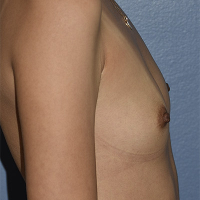 Before Image: Breast Augmentation - right-side