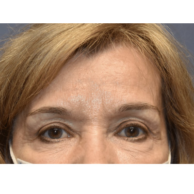 After Image: Blepharoplasty - front
