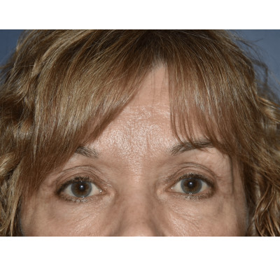 Before Image: Blepharoplasty - front