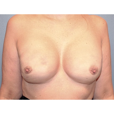 After Image: Nipple Sparing Implant Based - front