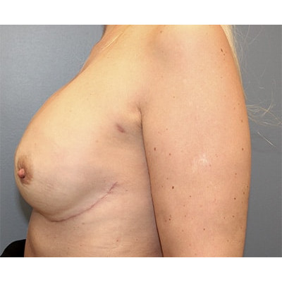 After Image: Nipple Sparing Implant Based - left-side
