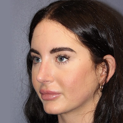 After Image: Rhinoplasty - left-front-oblique