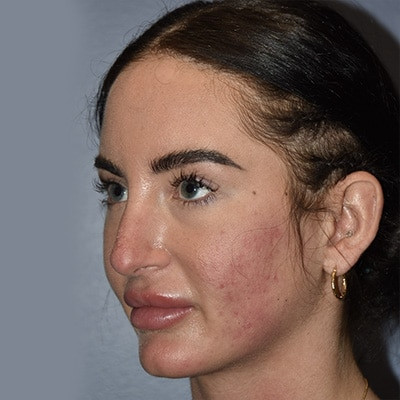 Before Image: Rhinoplasty - left-front-oblique