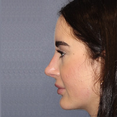 After Image: Rhinoplasty - left-side