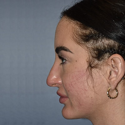 Before Image: Rhinoplasty - left-side