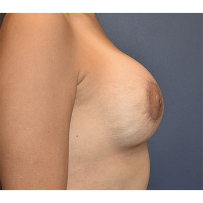 After Image: Breast Augmentation with Lift - right-side
