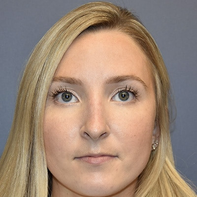 After Image: Rhinoplasty - front