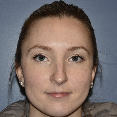 Before Image: Rhinoplasty - front