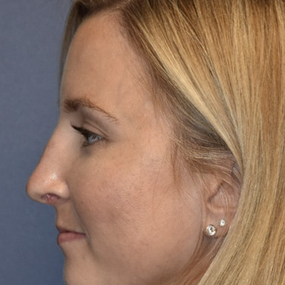 After Image: Rhinoplasty - other