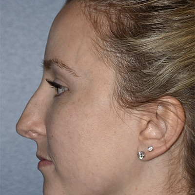 Before Image: Rhinoplasty - other