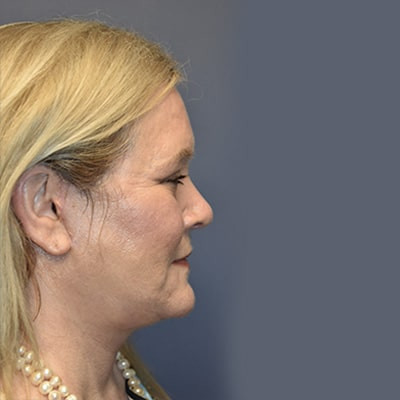 After Image: Necklift - other