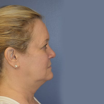 Before Image: Necklift - other