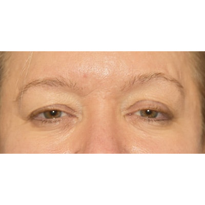 Before Image: Upper Eyelid Blepharoplasty - other