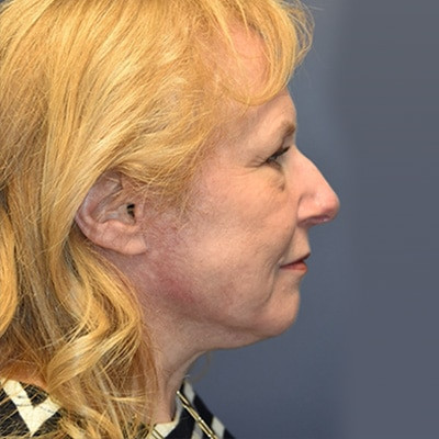 After Image: Necklift - other