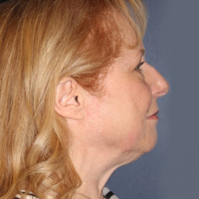 Before Image: Necklift - other
