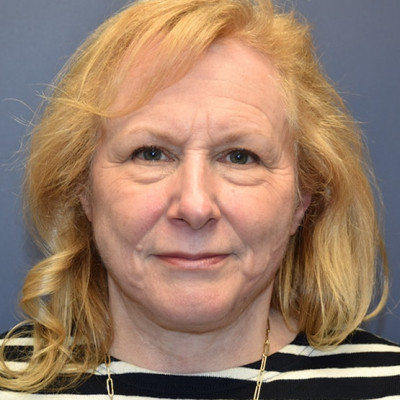 After Image: Facelift - front