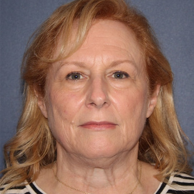 Before Image: Facelift - front