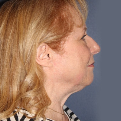 Before Image: Facelift - other