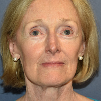 After Image: Facelift - front