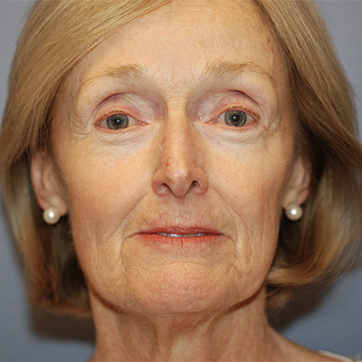 Before Image: Facelift - front